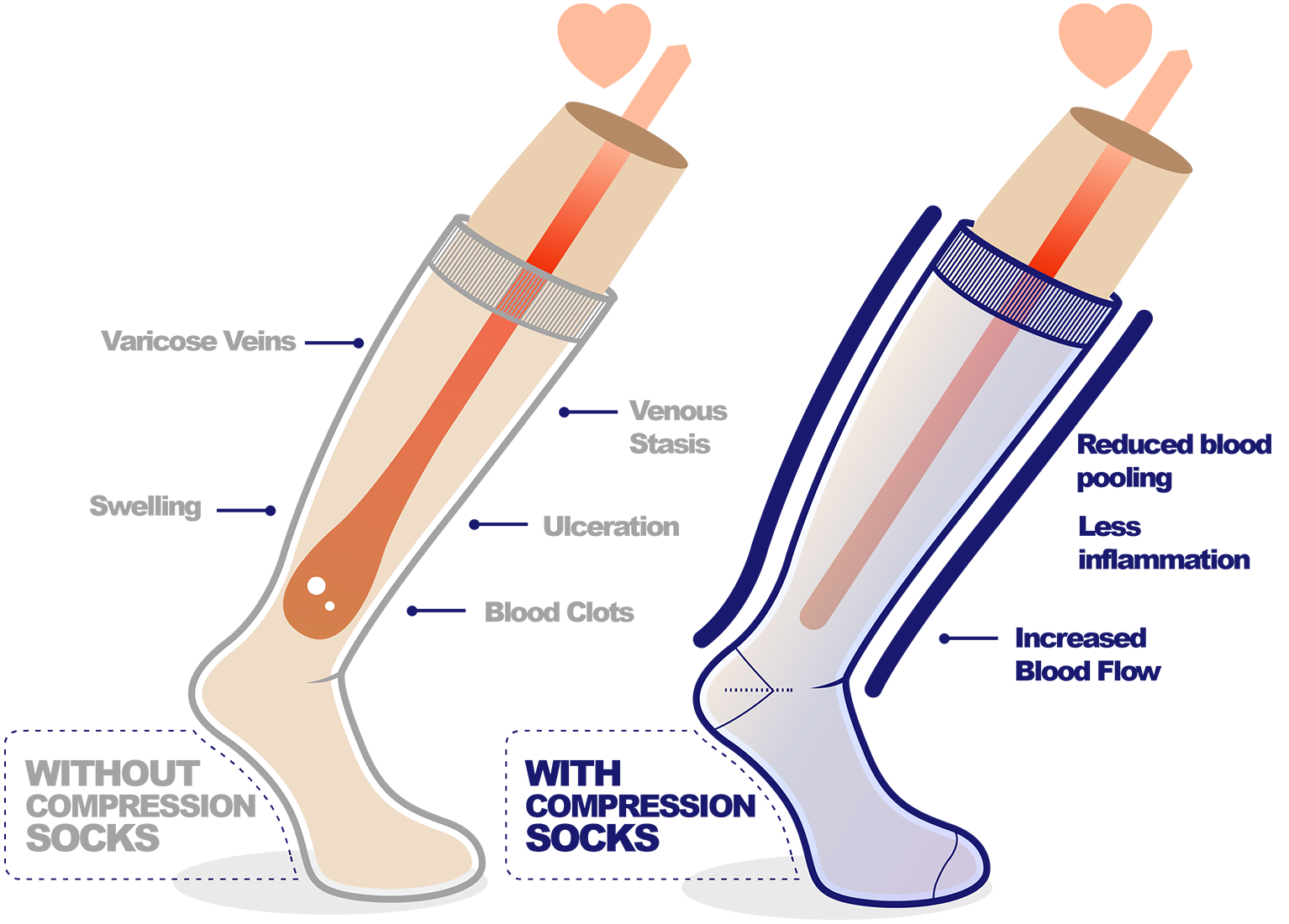 travelsox-graduated-compression-patent